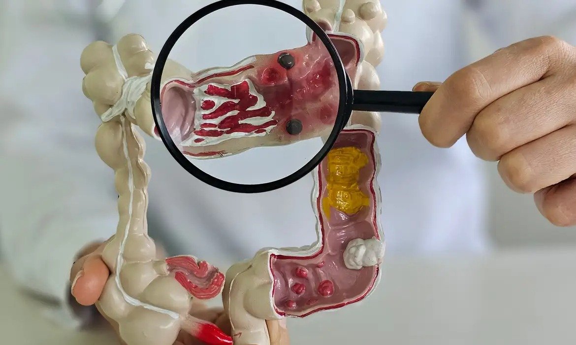 Novos casos de doenças intestinais aumentam no Brasil